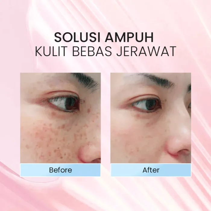 Vestme Acne Treatment Serum_Before After