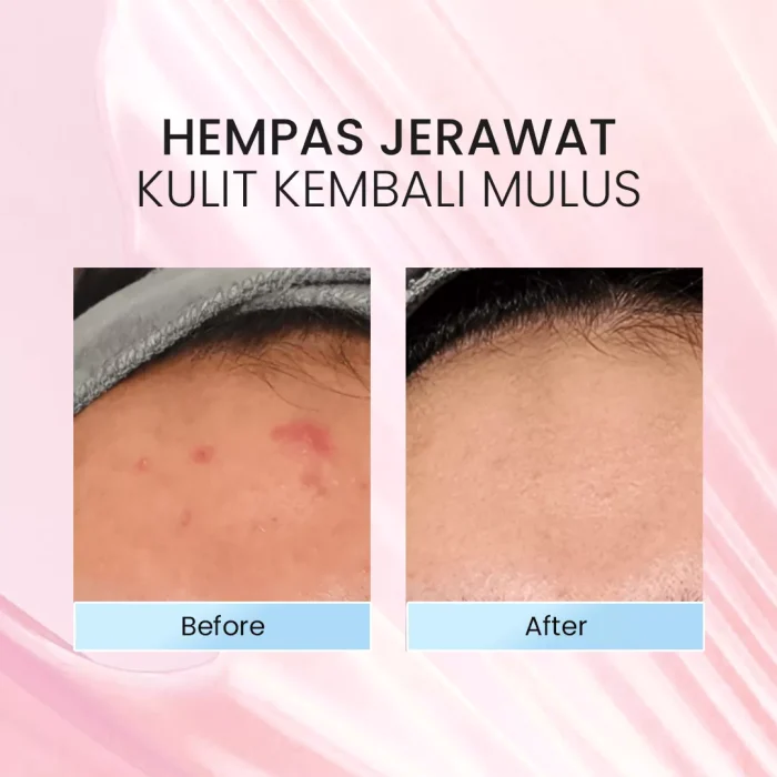 TLF Dual Acne Treatment 2 in 1_Before After