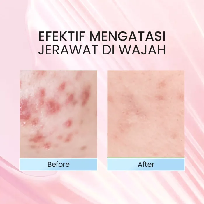 NPURE Cica Biome Acen Serum Essence Before After