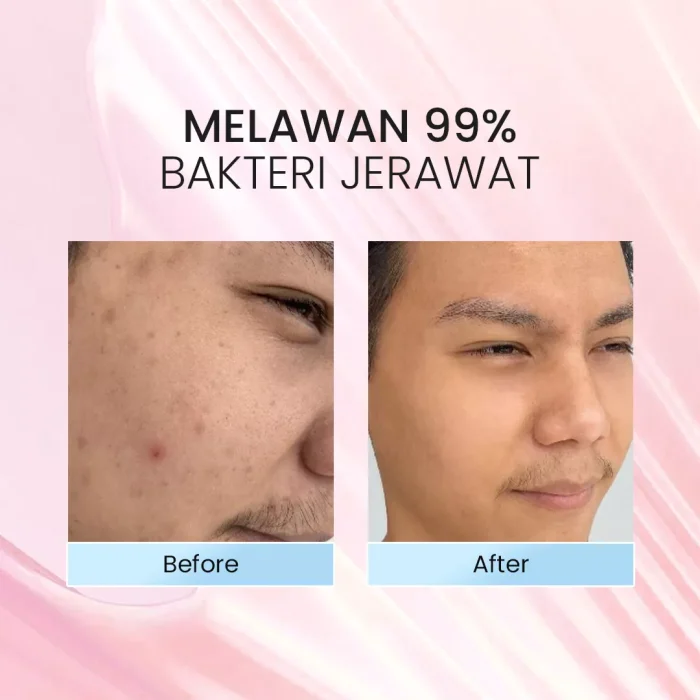 Bromen Acne Fight Expert Facial Wash Before After