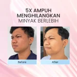 Bromen Oil Control Facial Wash Before After