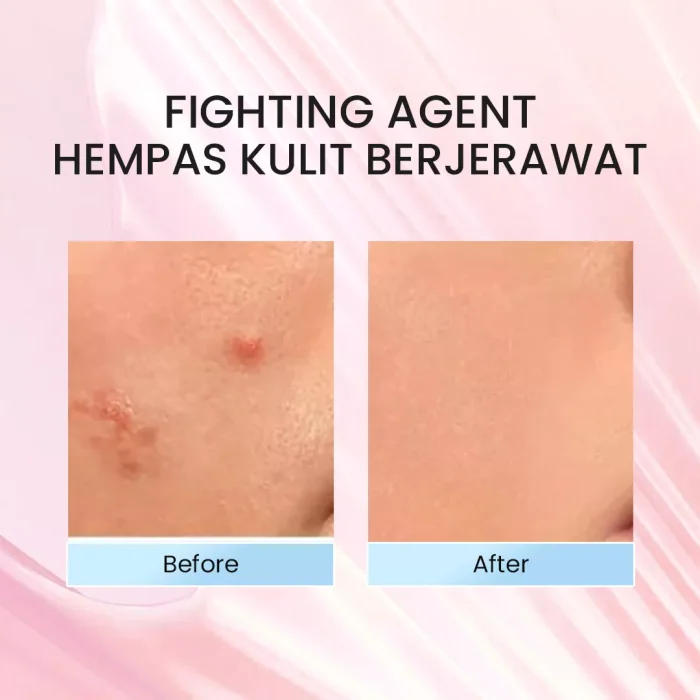 Implora Acne Spot Treatment _Before After