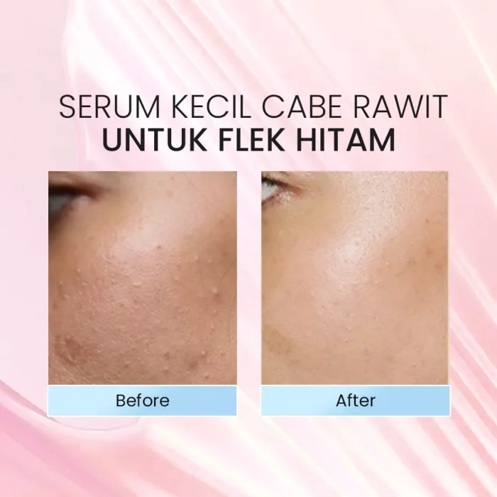 Lacoco Dark Spot Essence Before after