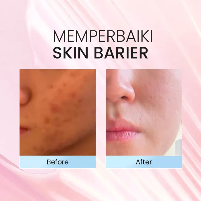 SKIN GAME KIND CREAM MOISTURIZER SKIN BARRIER Before after