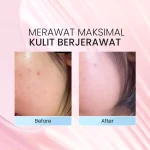 Lacoco Grape Fruit Acne Fighter Serum_Before after_